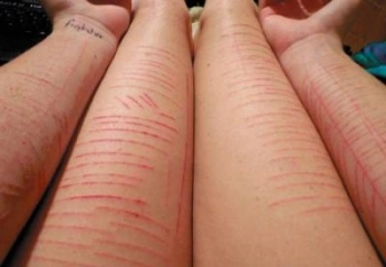 imagem de braços com cortes de automutilação